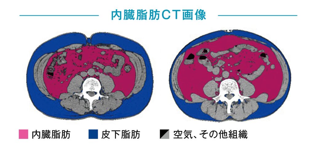 内臓脂肪CT検査による脂肪分布画像。内臓脂肪と皮下脂肪を可視化したCT断面図