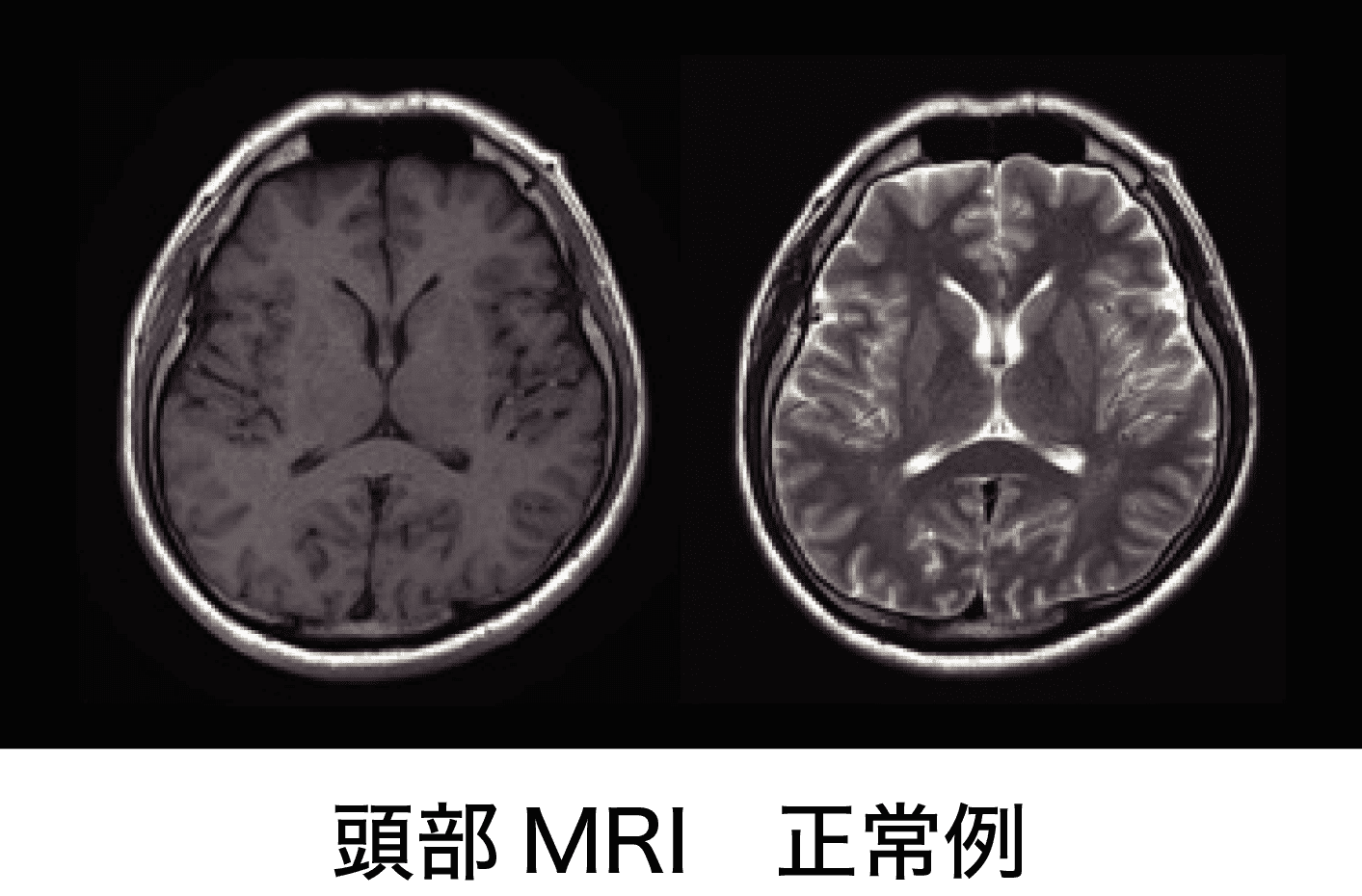頭部MRI 正常例